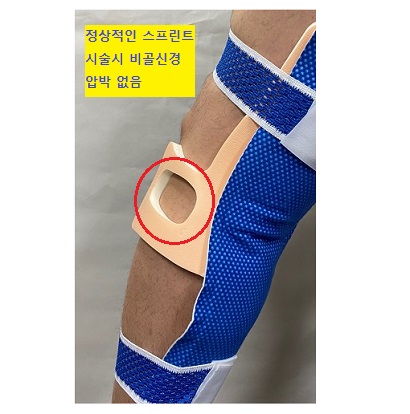 비골폼 착용사진 2.jpg